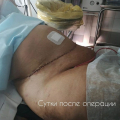 Абдоминопластика
